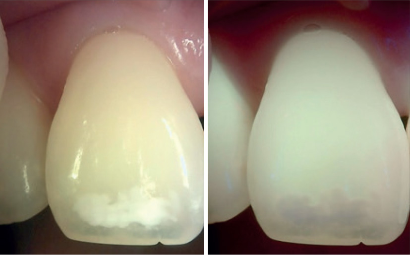 scansione dello smalto con Qraypen C a luce normale e QLF