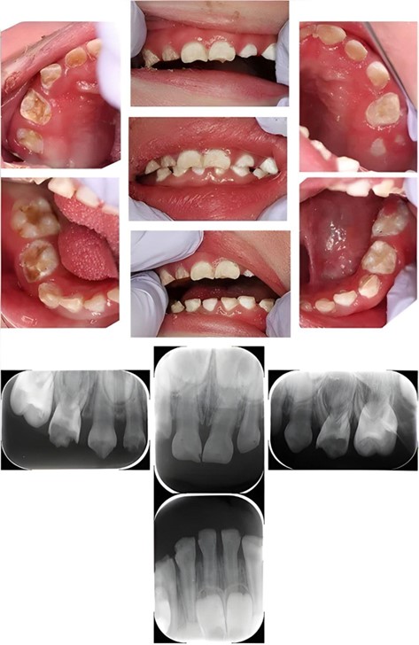 ittiosi in paziente pediatrico