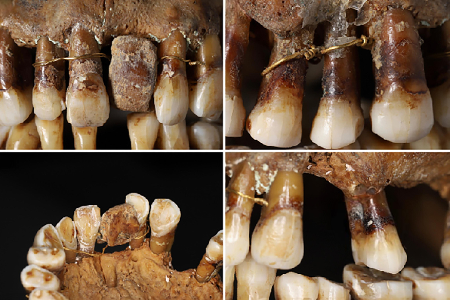 dentatura Anne d'Alègre