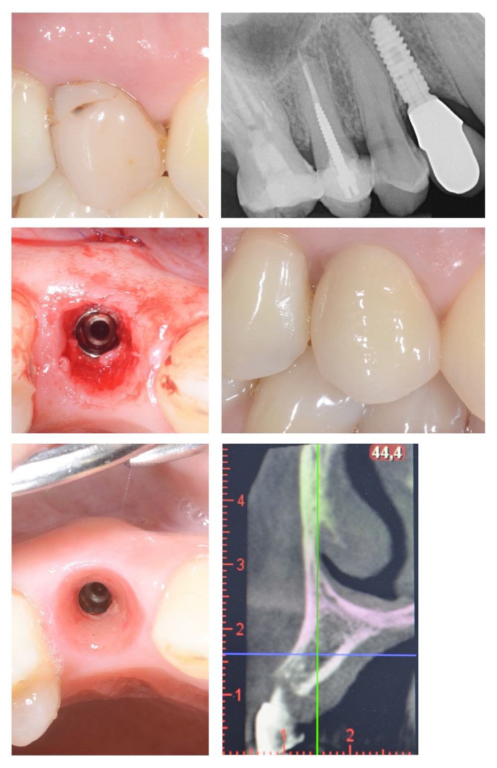 casi di implantologia