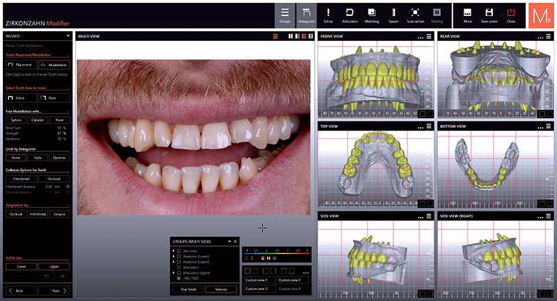 Progettazione dei restauri