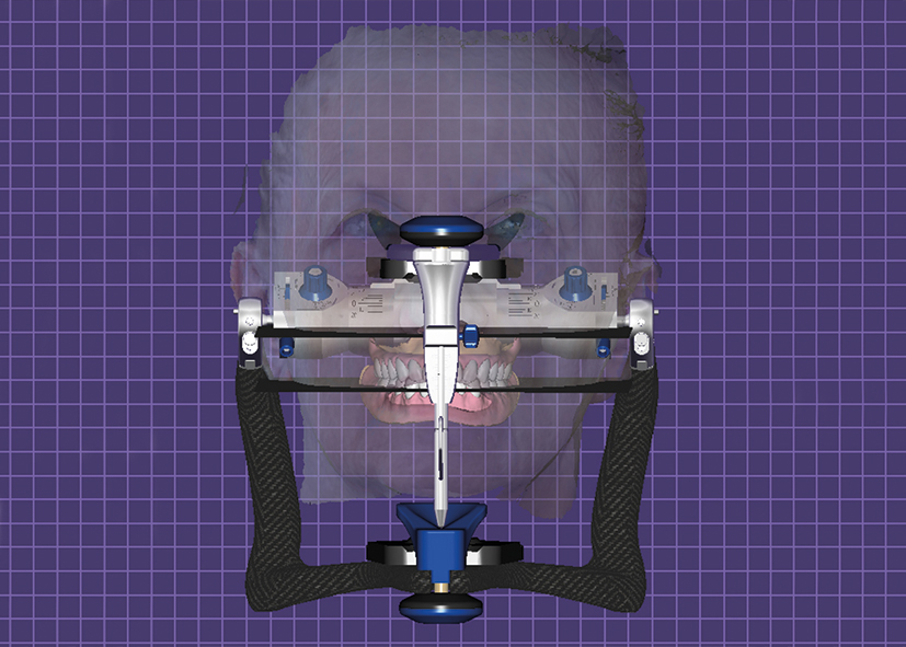 Fig. 6. Paziente virtuale inserito nel modulo Artex di Exocad.