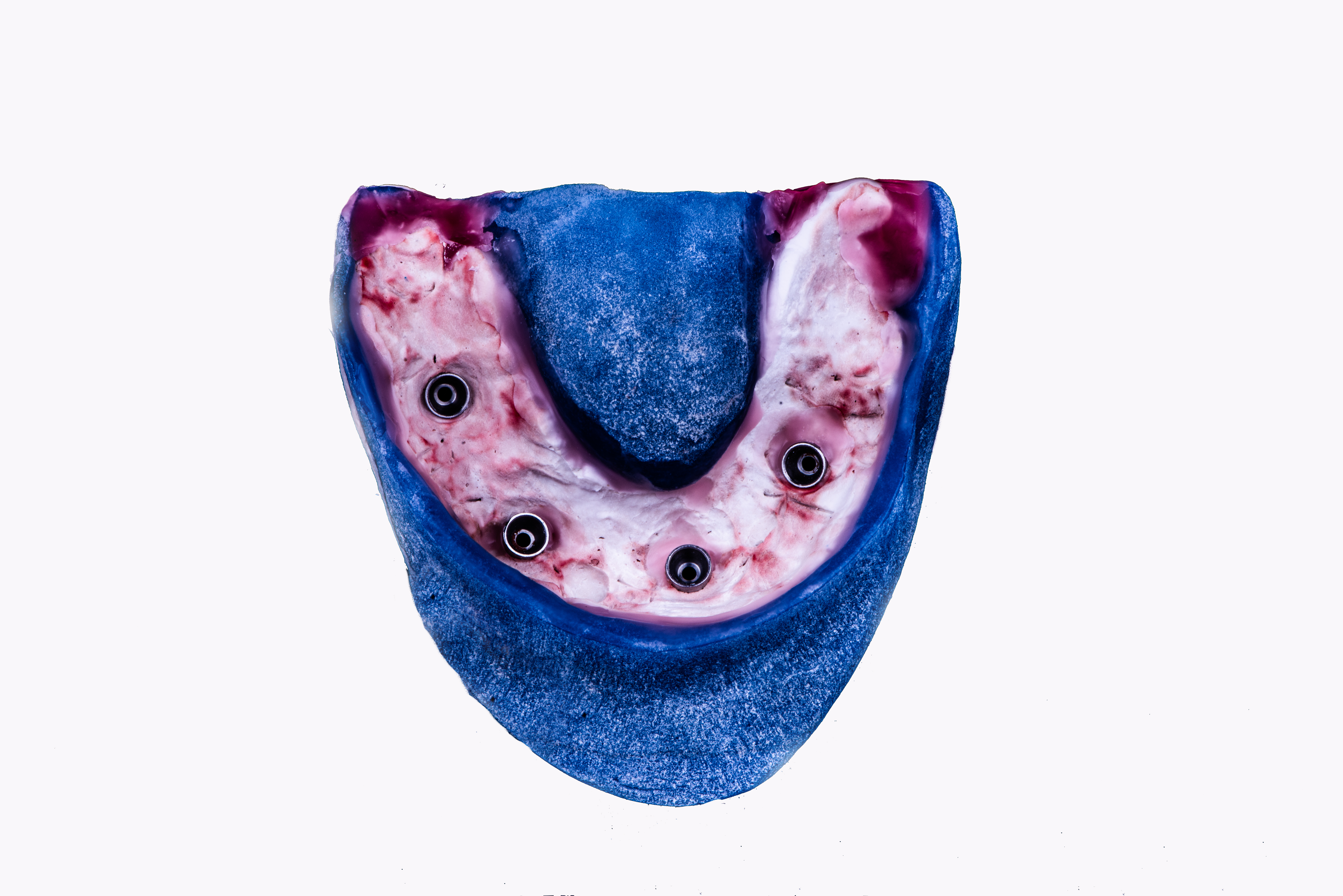 Fig. 12. Impronta in gesso in cucchiaio customizzato