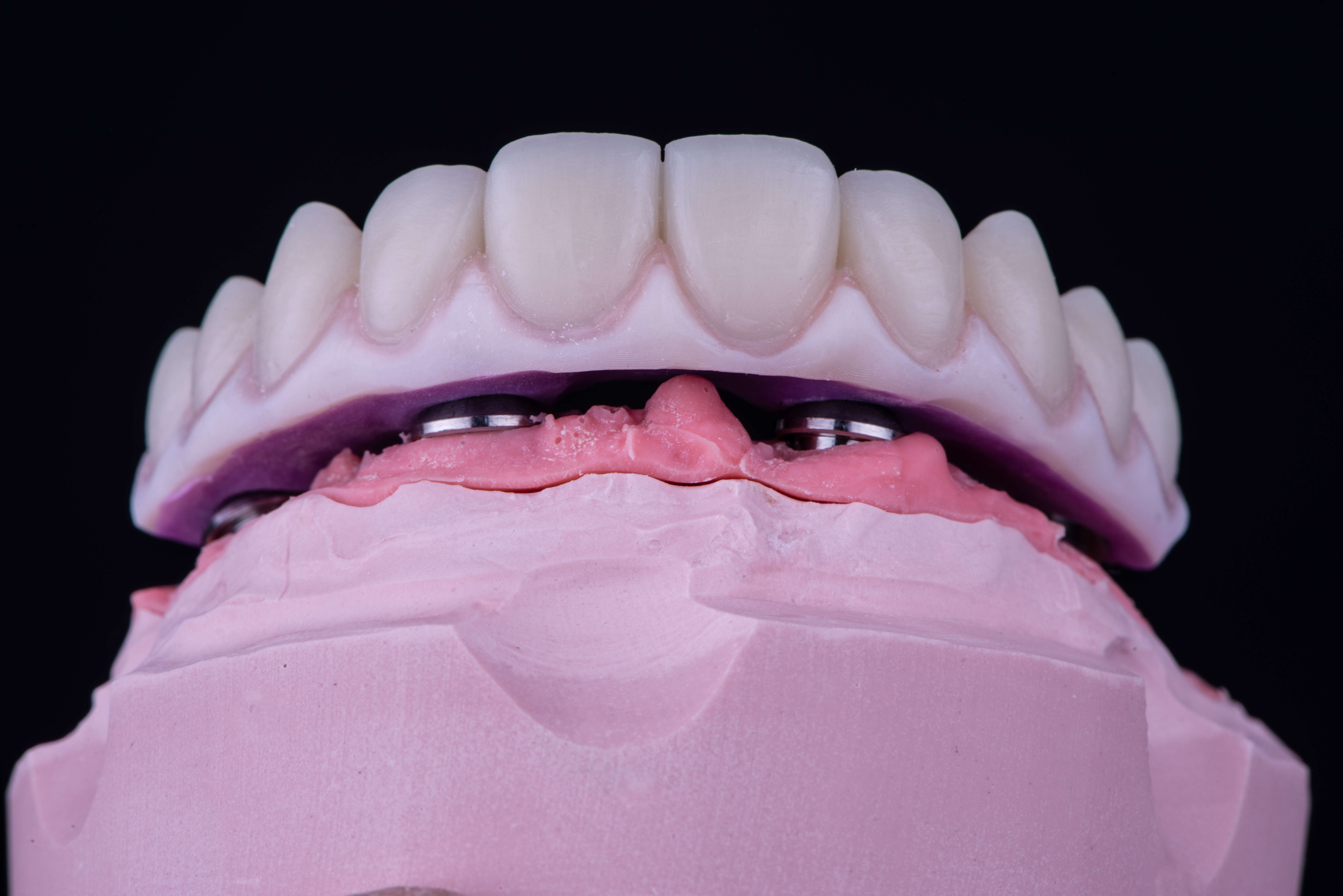 Fig. 13. Adattamento del prototipo sul modello in gesso derivato dall’impronta