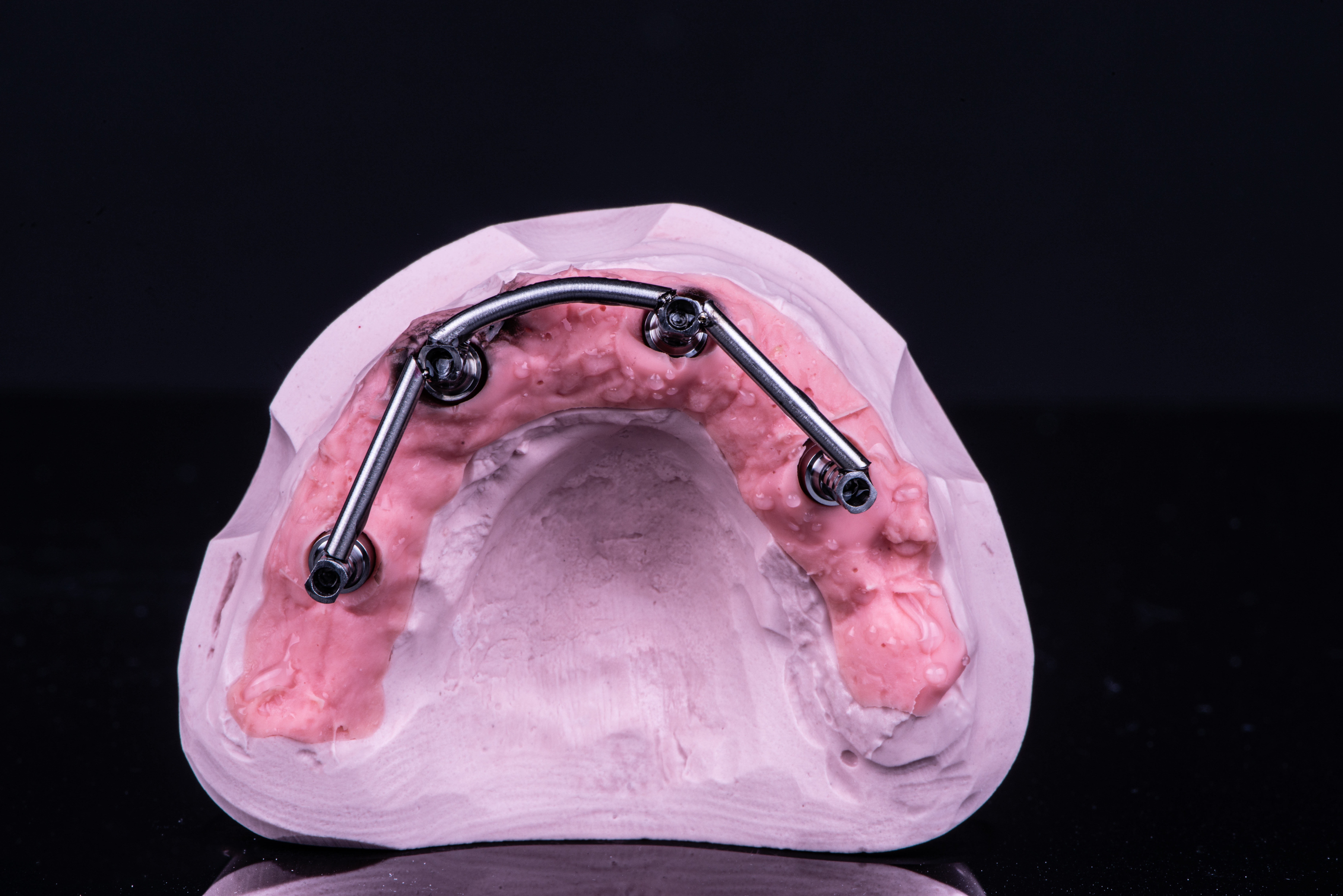 Fig. 15. Barra in titanio saldata sui due cilindri provvisori anteriori