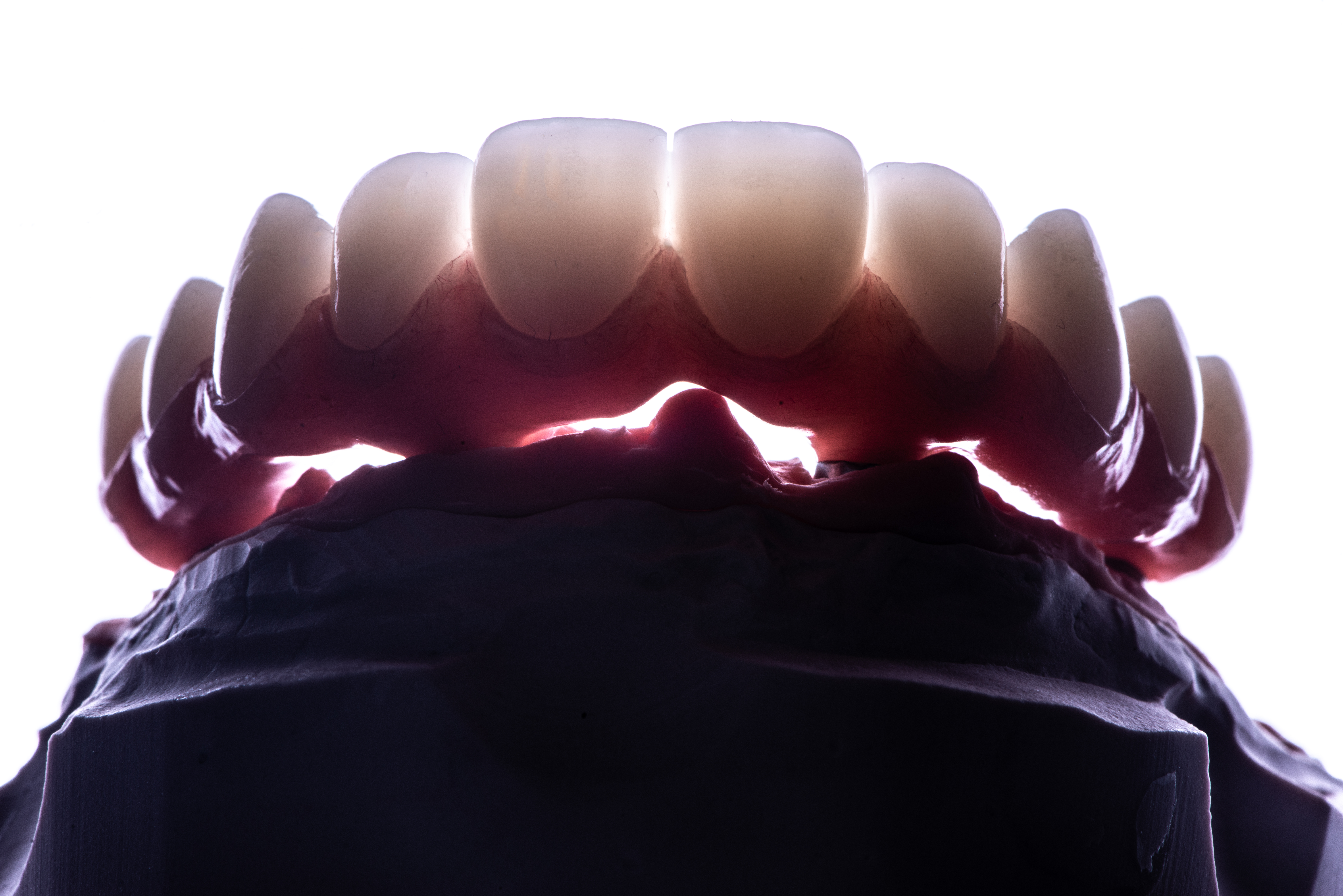 Fig. 16. Protesi provvisoria resinata