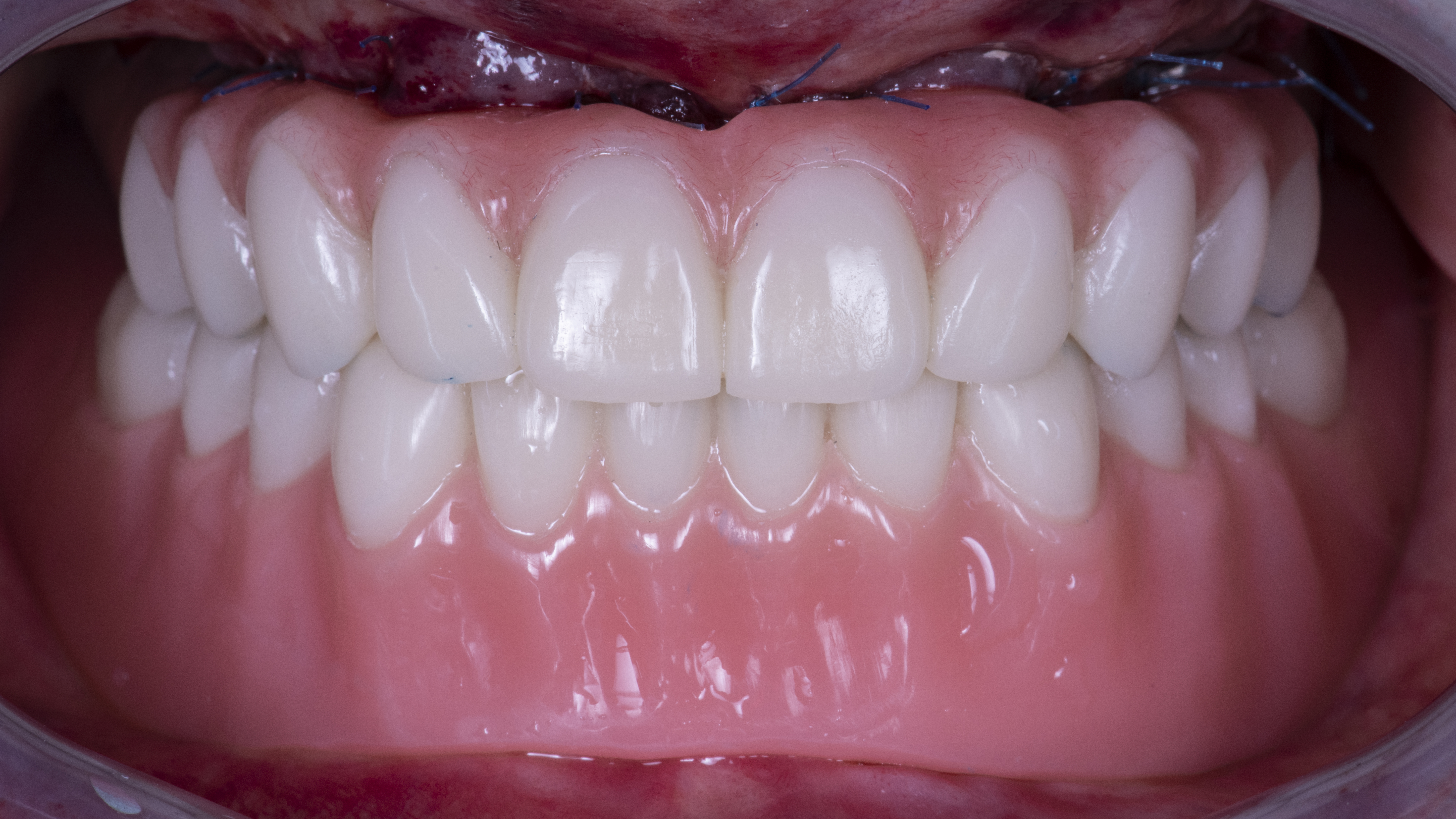 Fig. 17. Adattamento intraorale della protesi fissa provvisoria superiore e della protesi provvisoria mobile inferiore