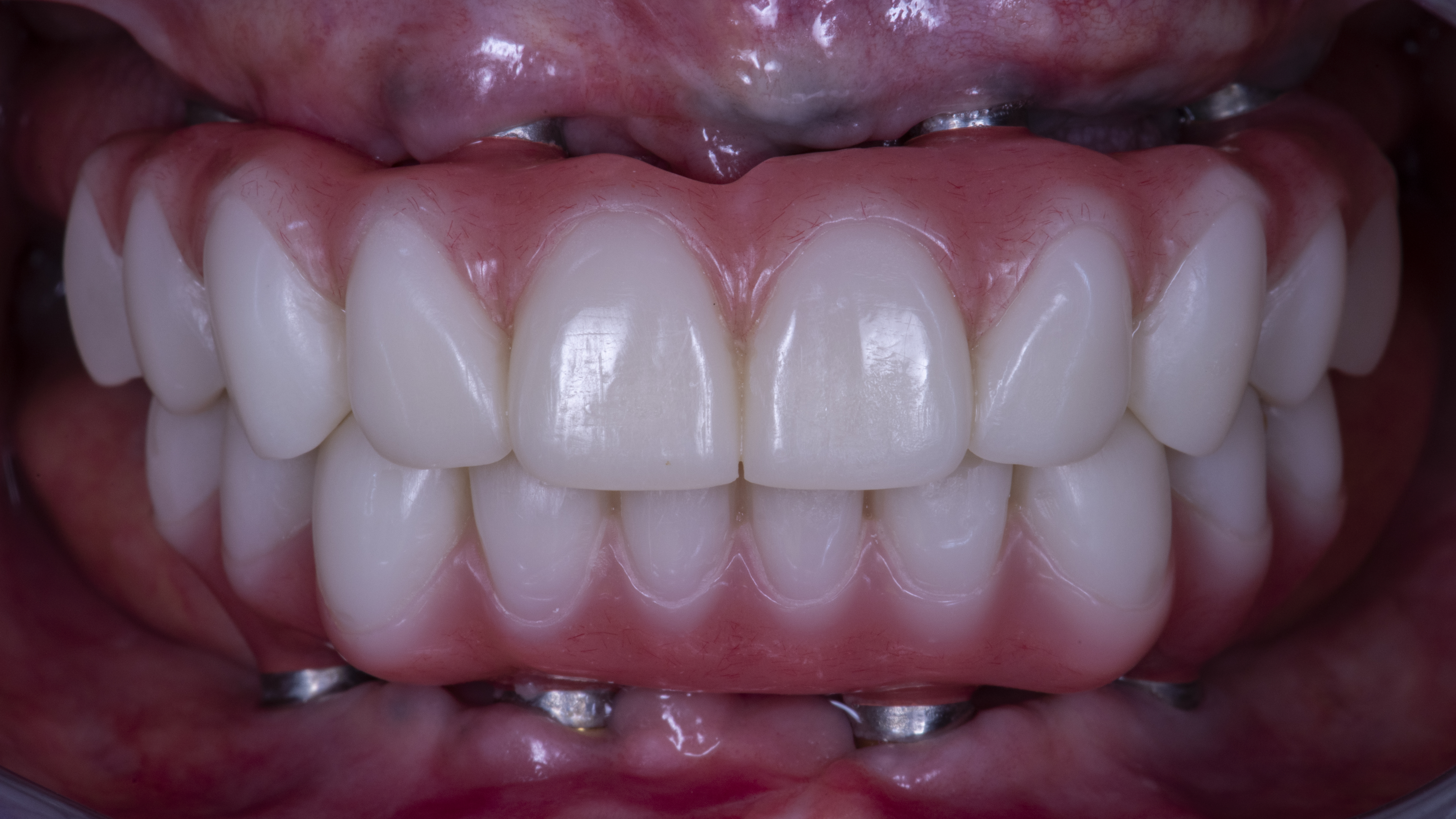 Fig. 18. Adattamento intraorale di entrambe le protesi provvisorie fisse