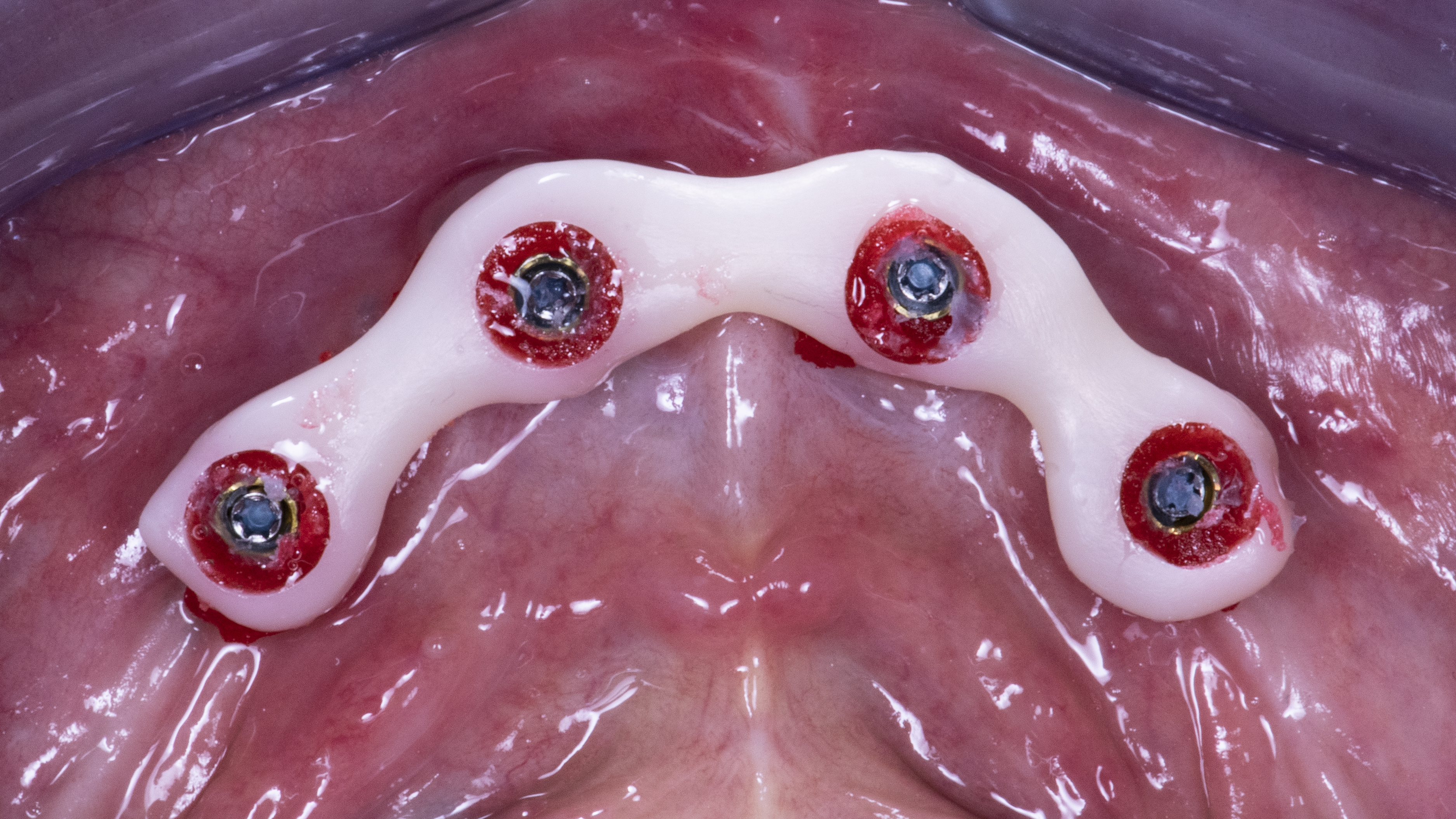 Fig. 19. Cementazione dei T-base nel gig in zirconia