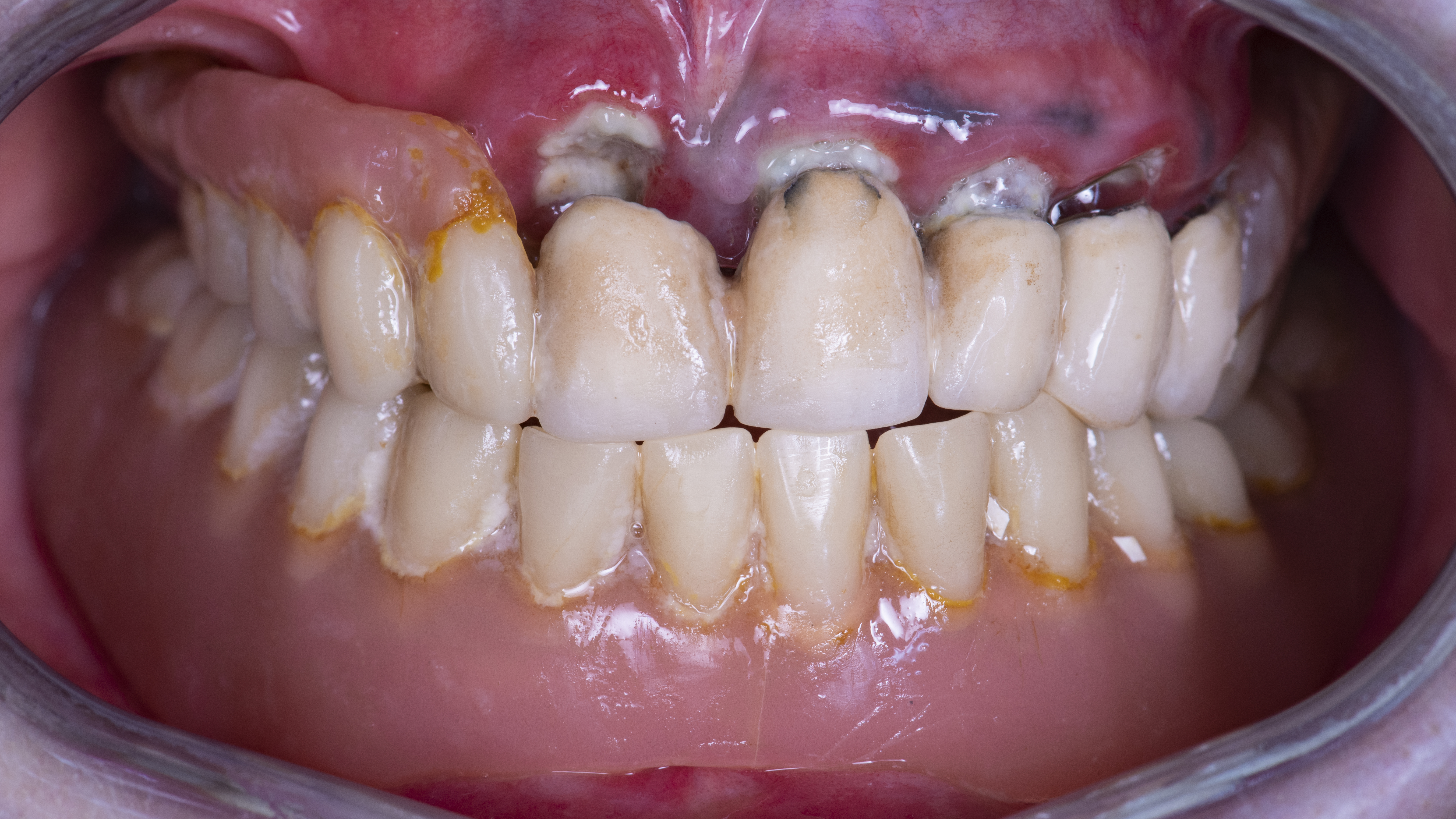 Fig. 2. Situazione iniziale aspetto intraorale