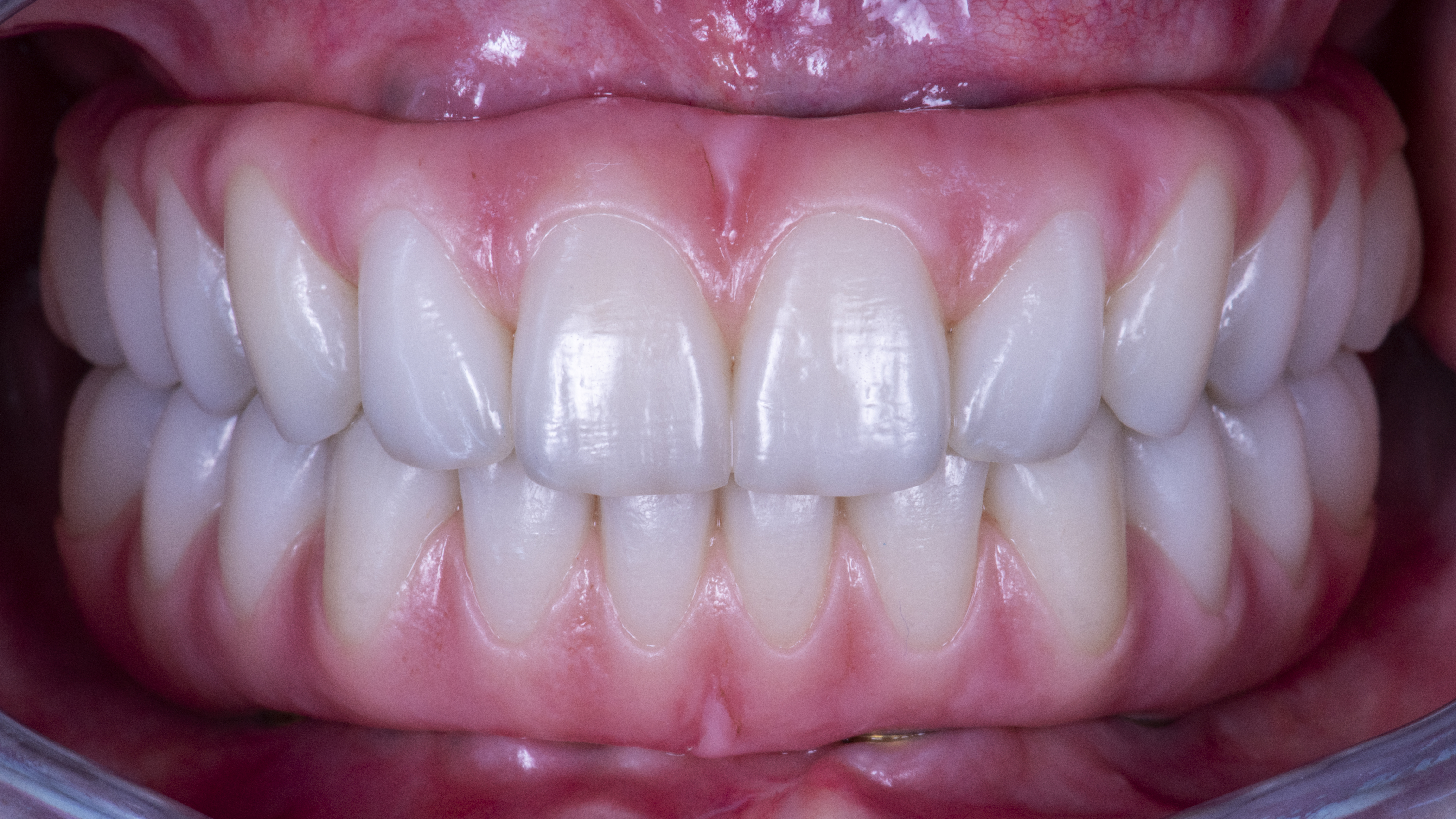 Fig. 20. Protesi definitive avvitate in zirconia monolitica stratificate solo nella componente rosa