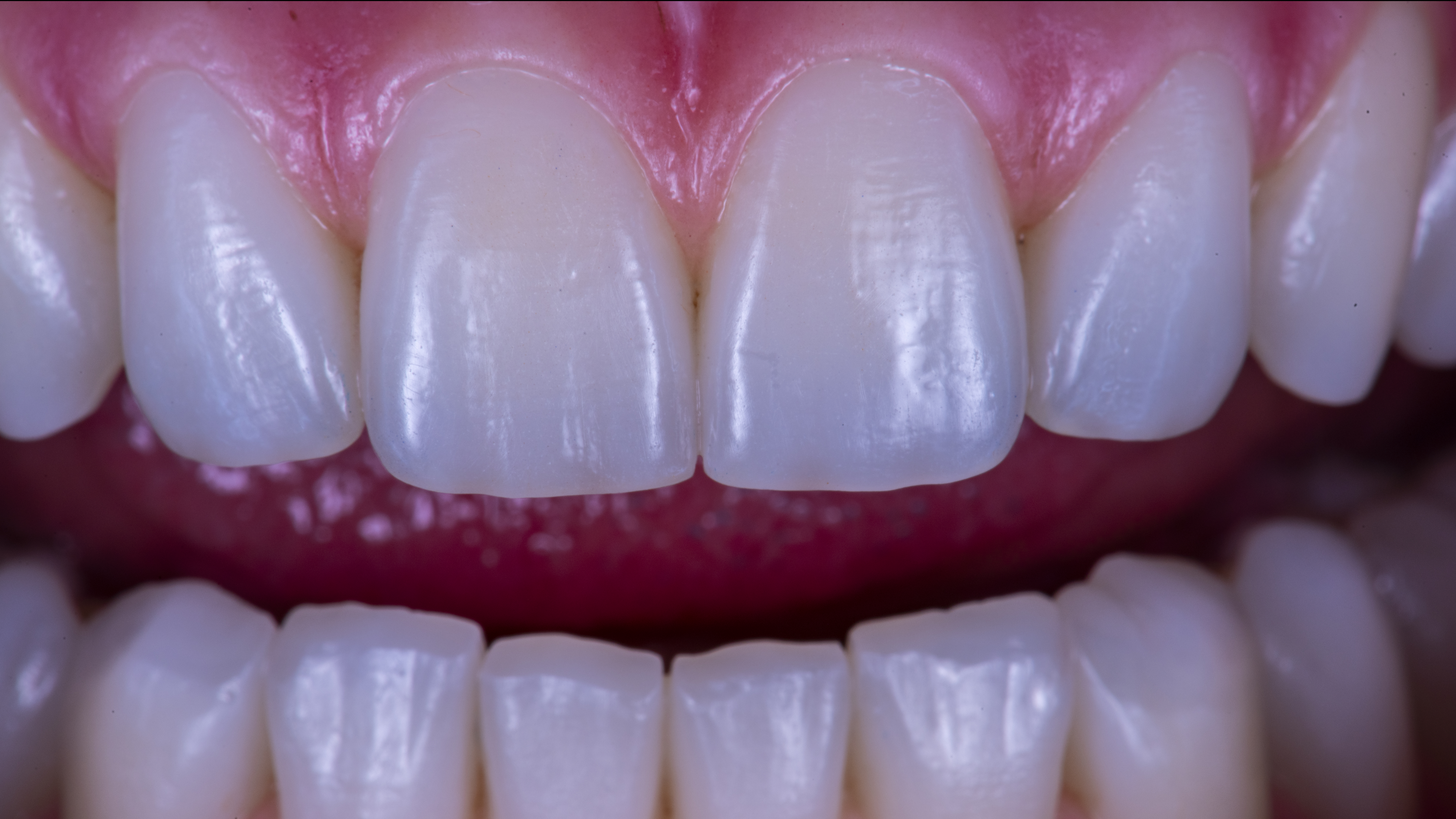 Fig. 21. Protesi definitive avvitate in zirconia monolitica stratificate solo nella componente rosa