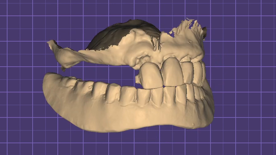 Fig. 3. Massima intercuspidazione rilevata con scanner intraorale