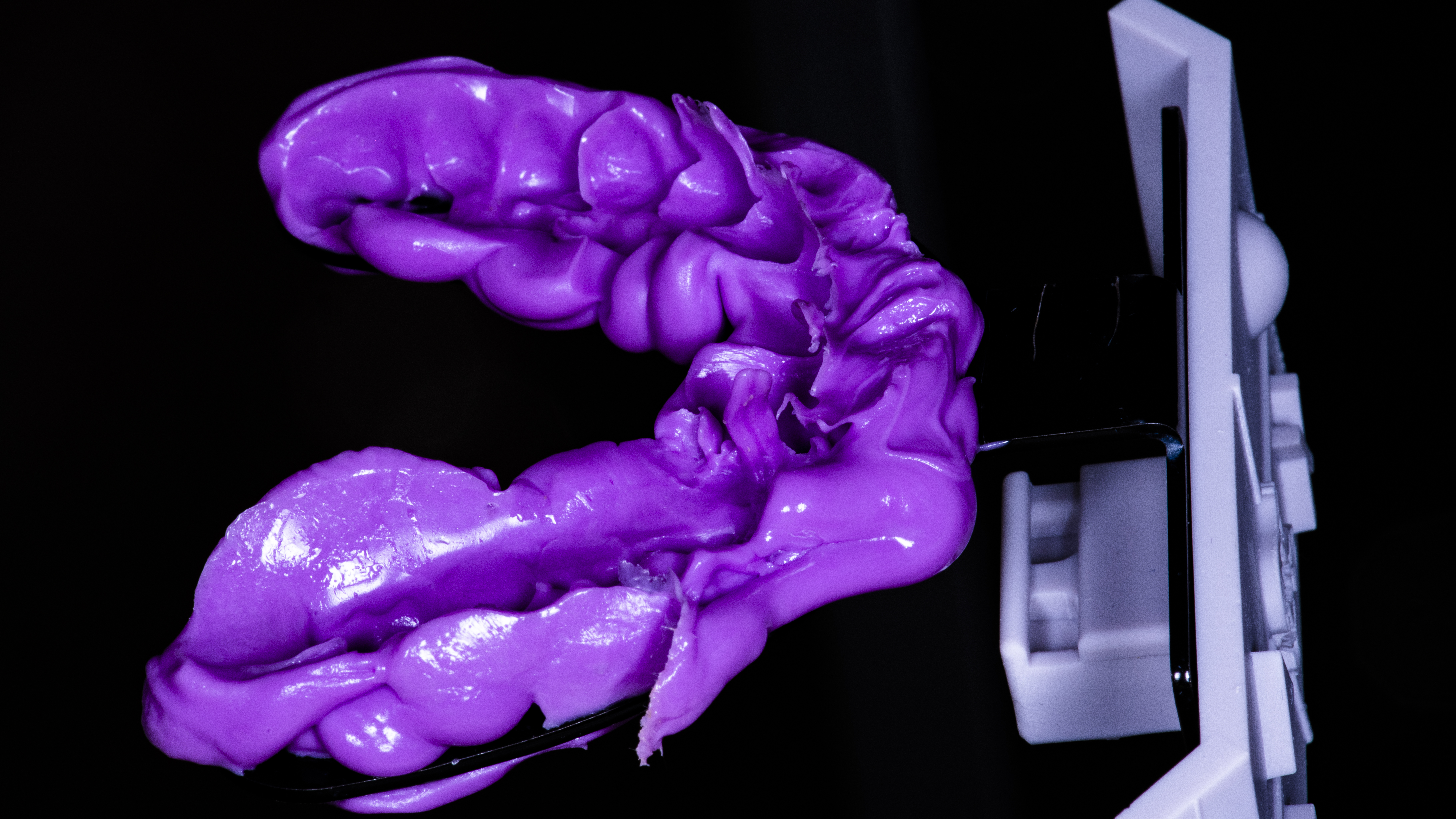 Fig. 5. Impronta dell’arcata superiore sul fork mediante silicone rigido a rapido indurimento.