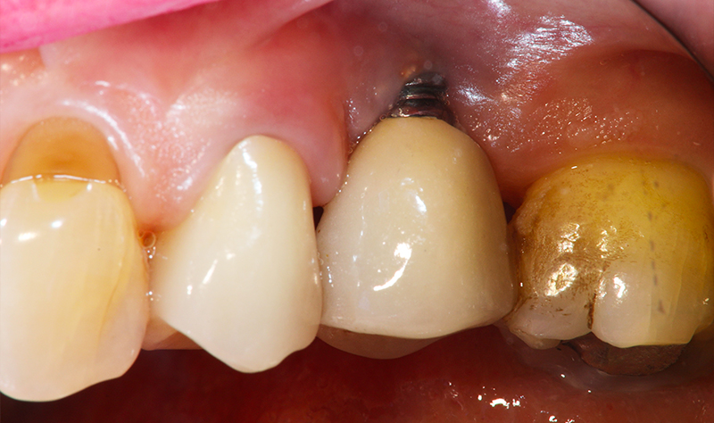 Rivalutazione a 1 mese