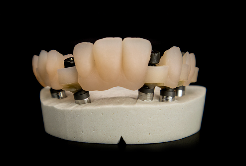 Concetto di De|Bug: utilizzando la ferula che incorpora gli ScanTransfer si costruisce una chiave in gesso con la posizione degli analoghi da laboratorio