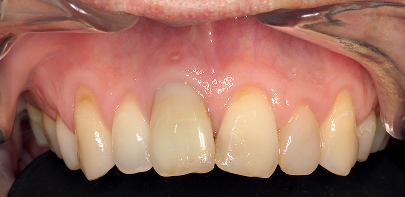 Quadro clinico iniziale