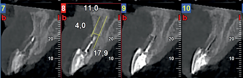 Pianificazione implantare con CBCT