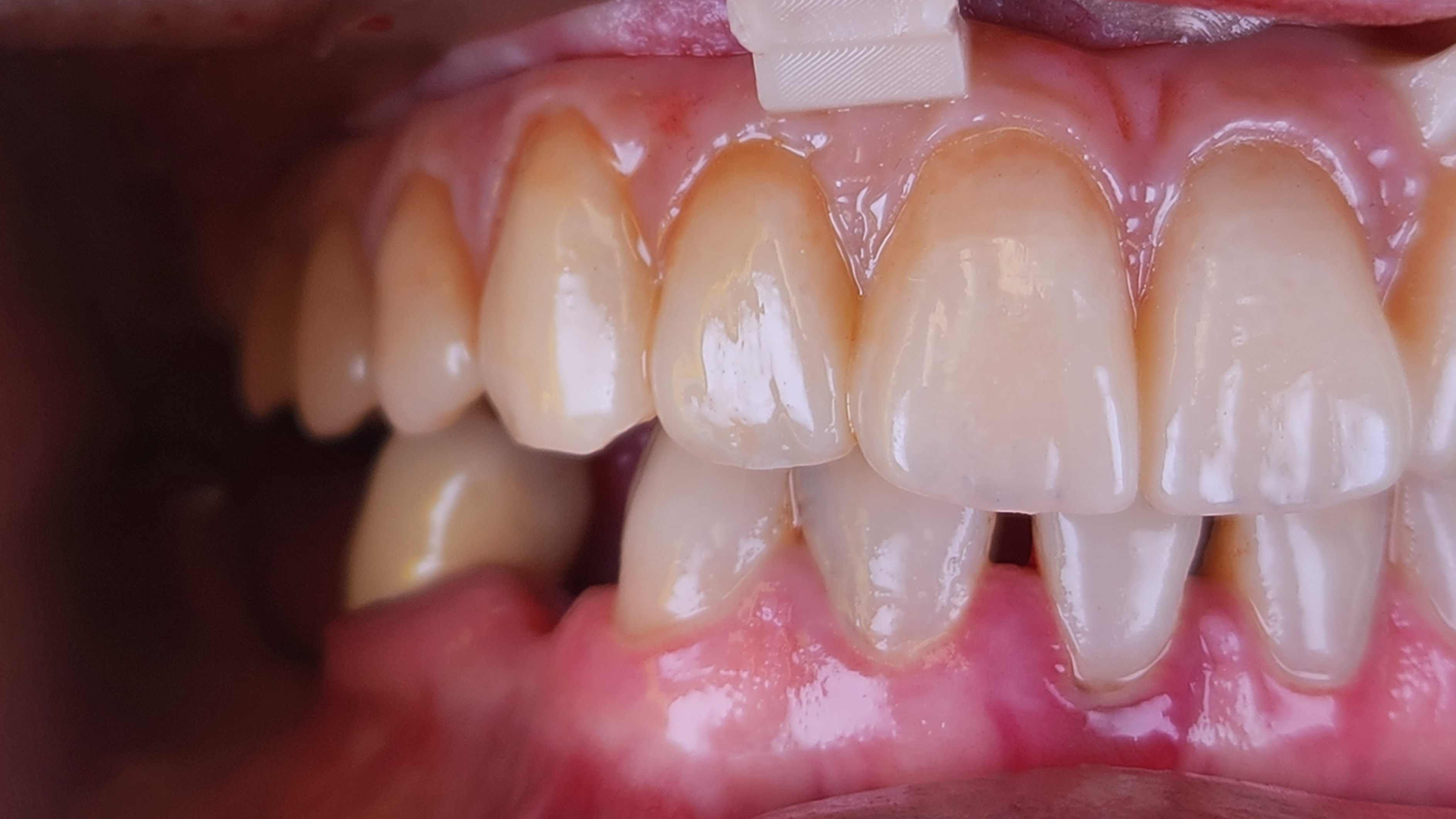 trattamento completato e protesi posizionata