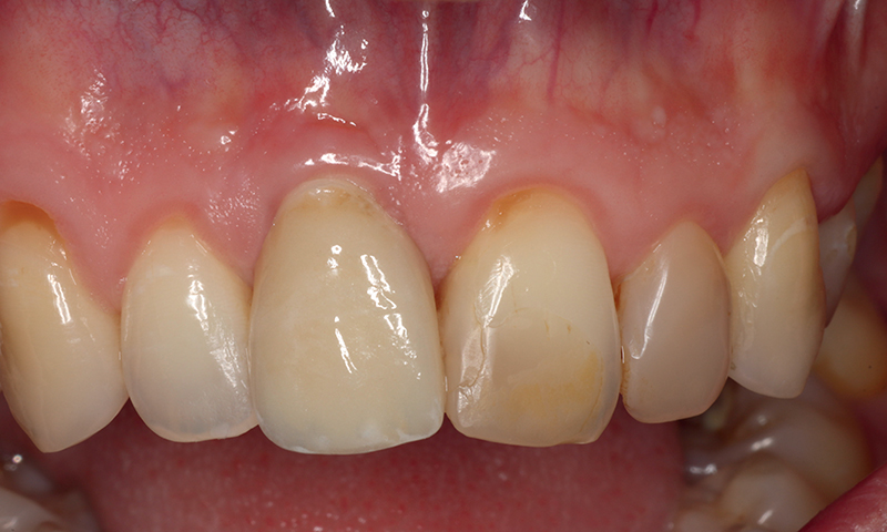 Quadro clinico frontale 5 anni dopo l'impianto