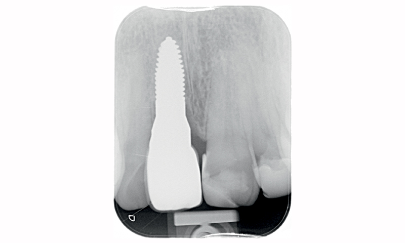 Radiografia 5 anni dopo l'inserimento dell'impianto