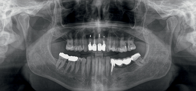 Radiografia panoramica pre-operatoria.