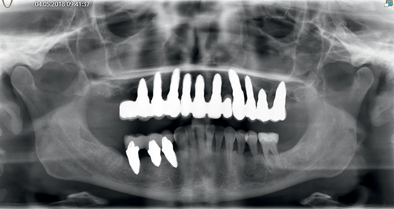 Immagine di controllo radiografica a 12 mesi dall'inserimento degli impianti