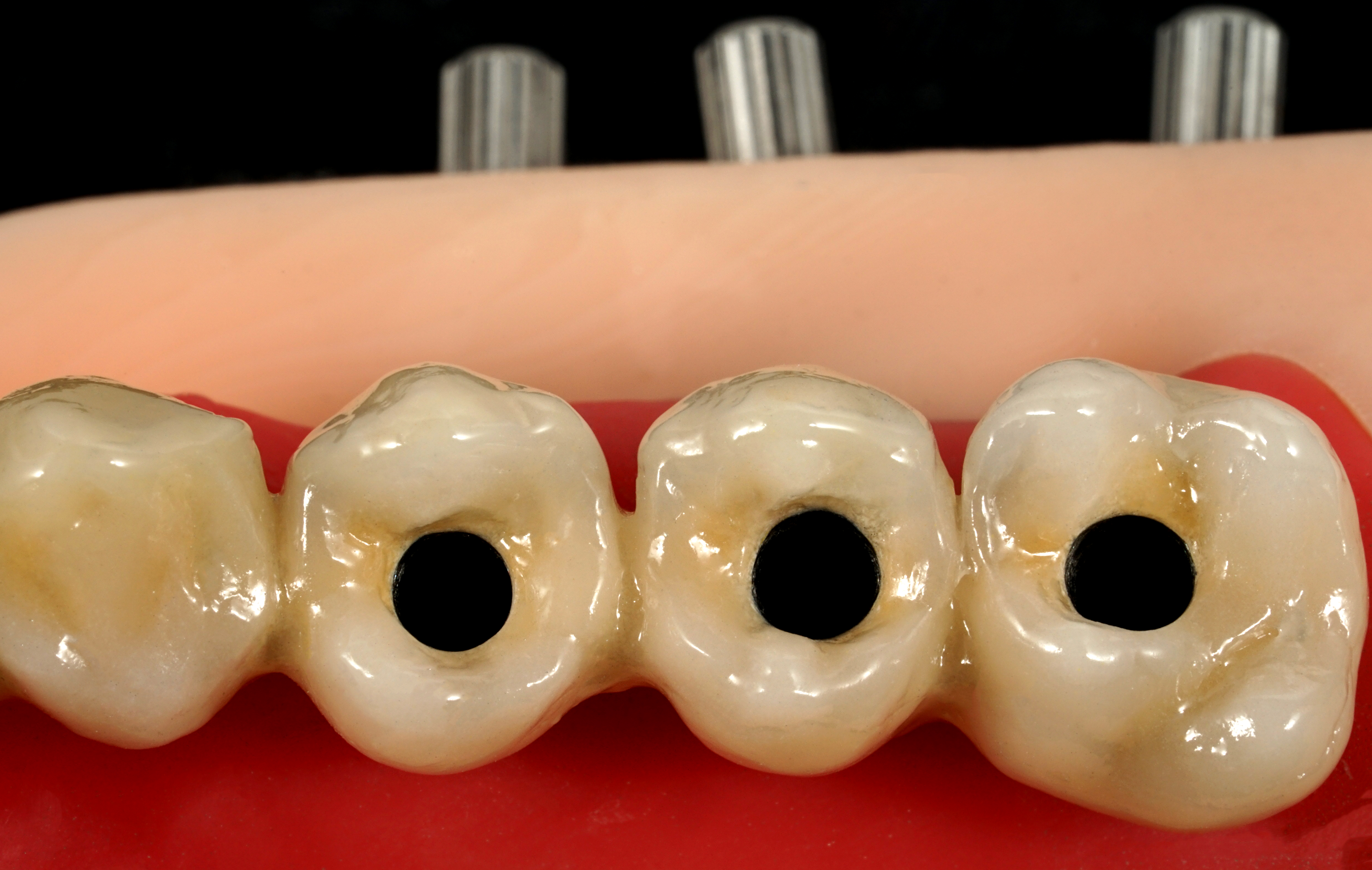 vista occlusale ceramizzazione