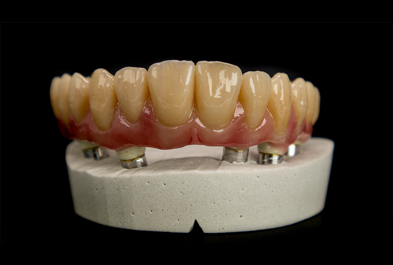 Incollaggio dei TiBase su chiave in gesso master