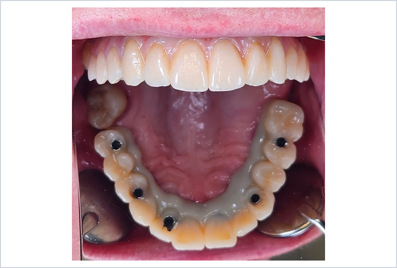 protesi provvisoria a carico immediato dopo l'integrazione degli impianti