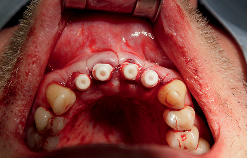 Vista clinica occlusale dopo l'inserimento degli impianti in zirconia.