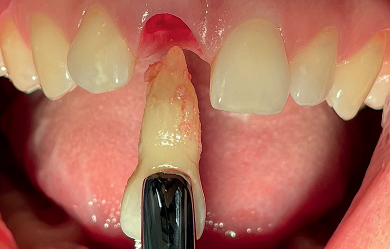 procedura mini-invasiva con conservazione della teca ossea vestibolare