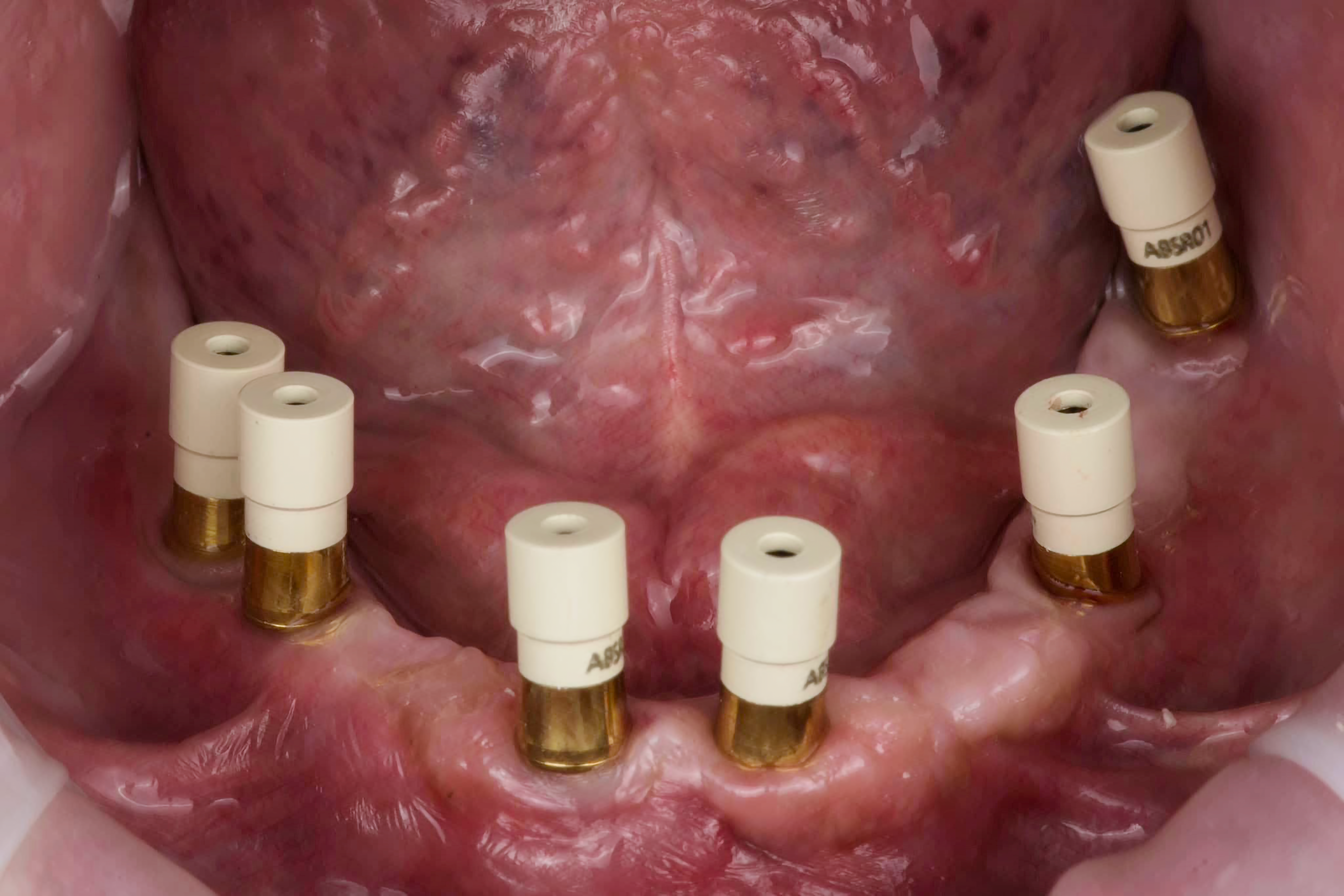 scanbody IDP intraorale