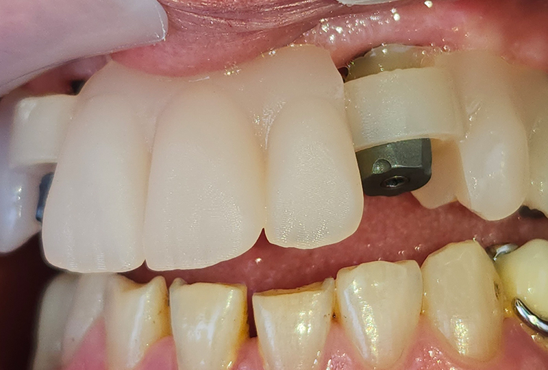 stampato del provvisorio usato come ferula di bloccaggio degli Scan| Transfer