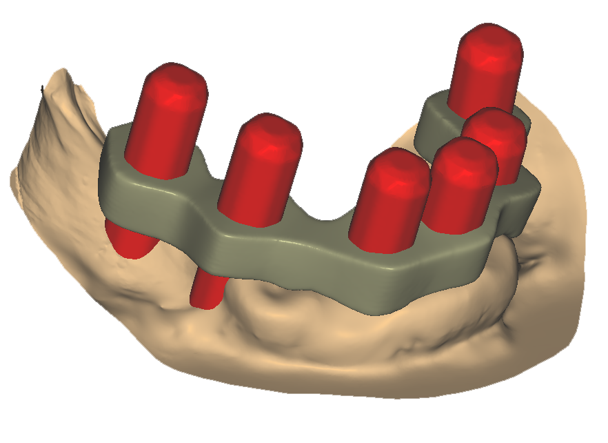 ferula scansione intraorale