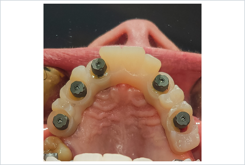 concetto di CSS| Strategy: creare un percorso facilmente leggibile dagli scanner attraverso il collegamento alle teste degli scanbody