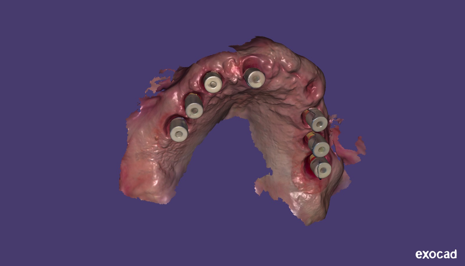 Scansione intraorale Exocad