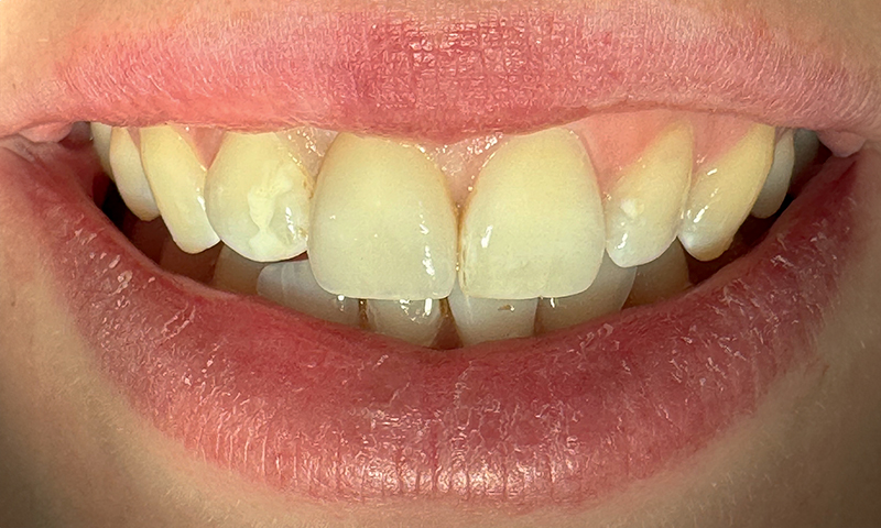 Cementazione della corona definitiva