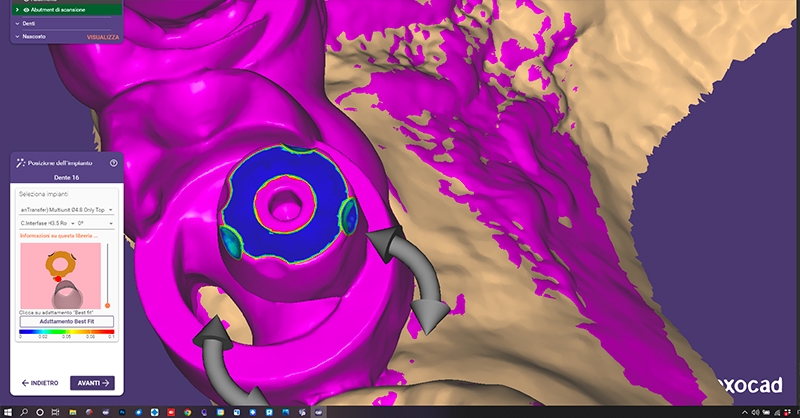 Accoppiamento "Only Top" delle librerie sulla scansione importata in cad