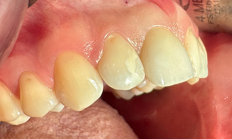 visione laterale con preservazione della cresta alveolare buccale