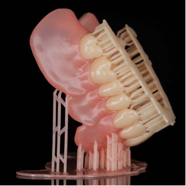 Protesi totale mobile definitiva realizzata in stampa 3D a doppio materiale