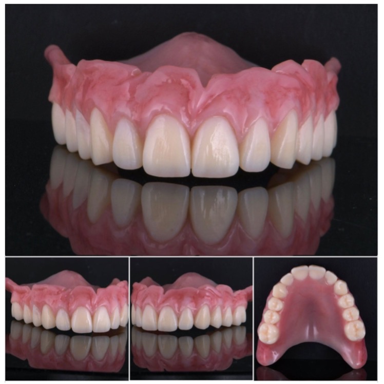 Protesi totale superiore realizzata in stampa 3D multi-materiale con tecnologia Stratasys J5 DentaJet e resina TrueDent-D