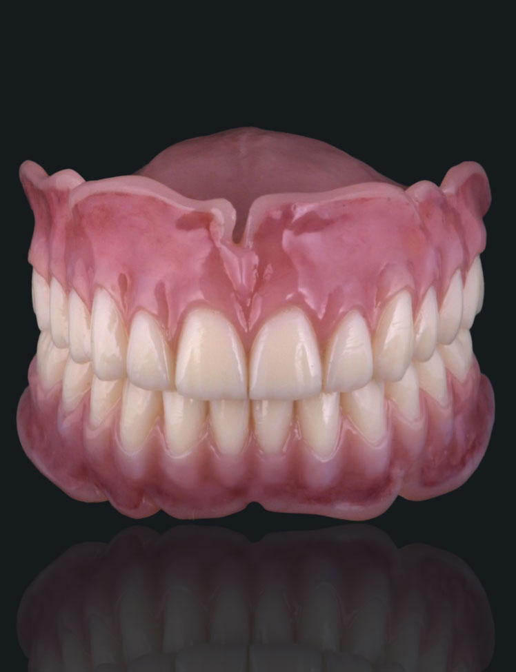 Protesi totale multi-materiale stampata in 3D