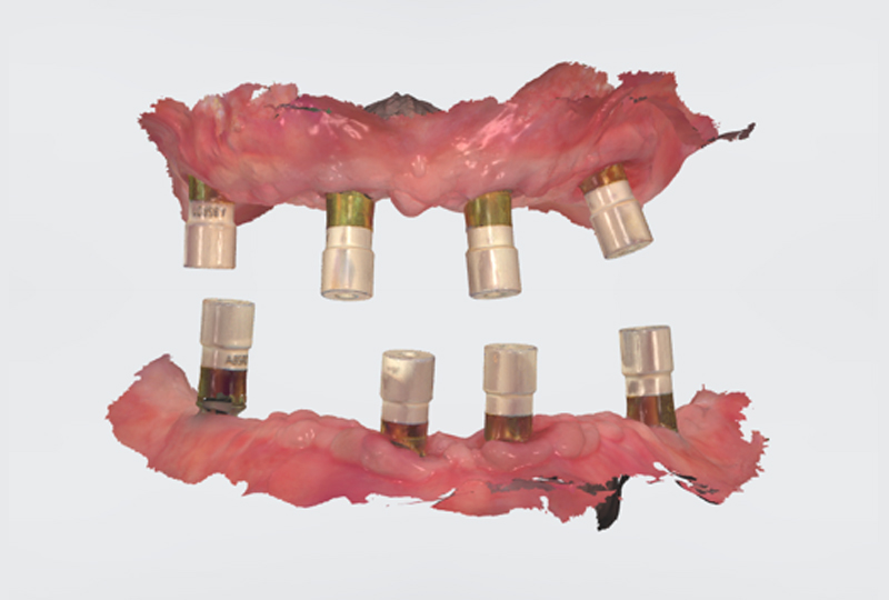 Scansione intraorale arcate con scanbody avvitati