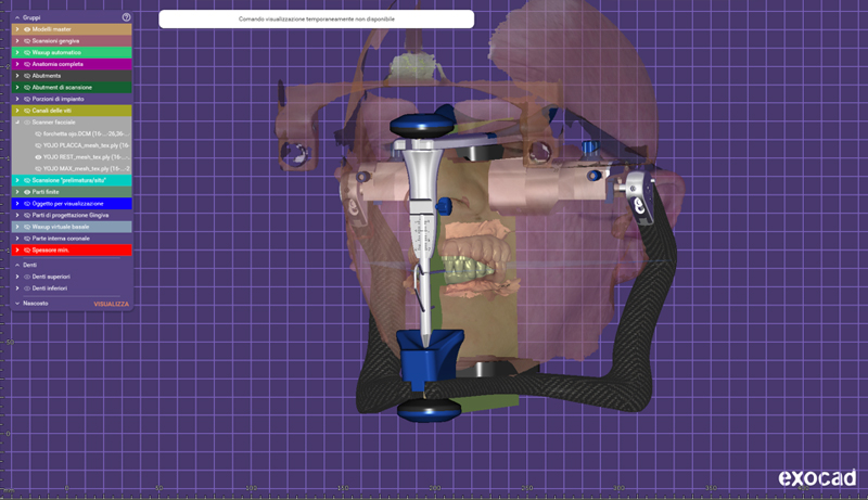 arcate dentali inserite nell'articolatore virtuale