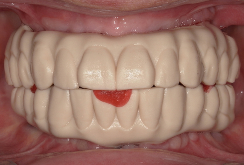 prototipi delle protesi stampate in 3D