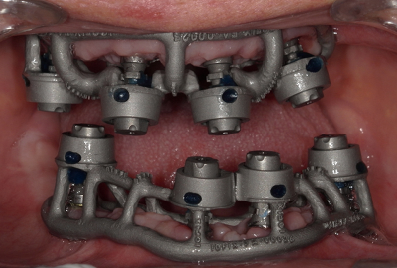 fissazione del Ringfix mediante resina fotopolimerizzabile agli scanbody