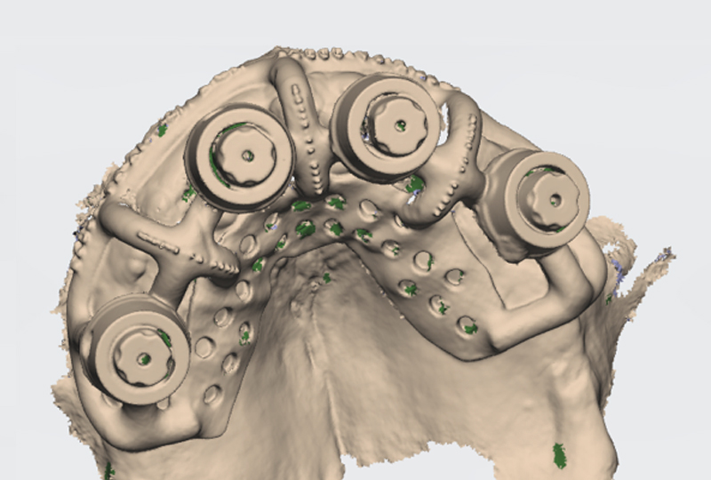 scansione Ringfix-Scantransfer
