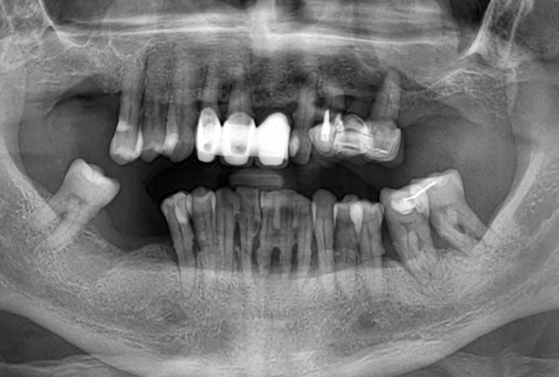 vecchia riabilitazione con protesi fissa superiore