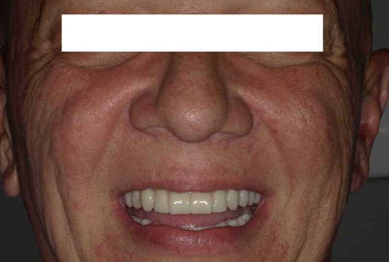 foto extra-orale con protesi definitive